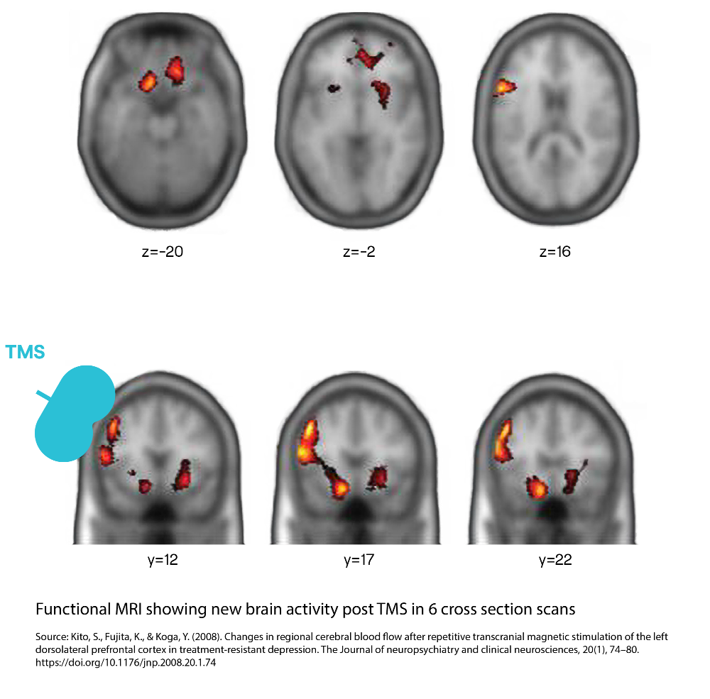 fmri-cross-section-scans-tms-increases-brain-activity-1-1